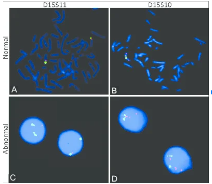 Syndrome de Prader-Willi FISH,Diagnosis of Prader-Willi/Angelman syndrome using FISH with 2 types of Prader-Willi/Angelman Region Probes